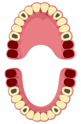 12 Elementi Dentari su 4 Impianti in Arcata Superiore. 12 Elementi Dentari su altrettanti 4 Impianti in Arcata Inferiore